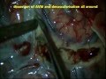 Brain ARTERIO-VENOUS-MALFORMATION-microsurgical excision-dr suresh dugani/HUBLI/INDIA