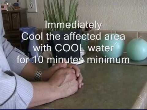 how to treat 1st degree burns