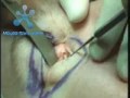 Eyelid Surgery (Blepharoplasty) Procedure Video Eyelid Surgery (Blepharoplasty) Procedure Video