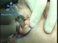 Eyelid Surgery (Blepharoplasty) Procedure Video