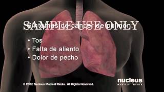 Cancer de Pulmon:
