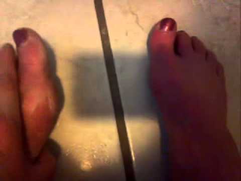 how to cure erythromelalgia