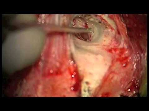 how to drain ruptured eardrum