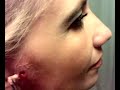 ha ha!!! this little girl got the first spider bite!! this one was pretty bad, but not as bad as mine!!