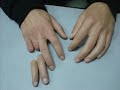 Silikon Parmak Protezi [ REHA Ortopedi 8 ] M.Zeki ÇULCU