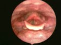 Mal Webb's Larynx... better quality this time