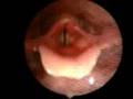Mal Webb's Larynx... better quality this time