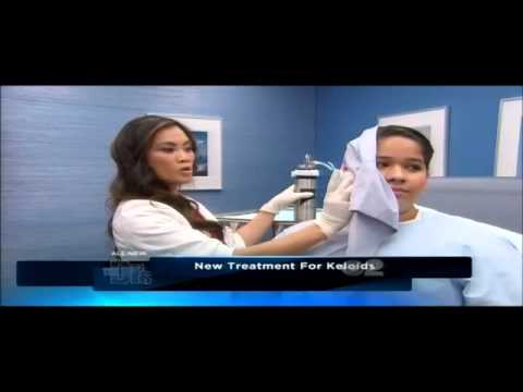 how to relieve keloid pain