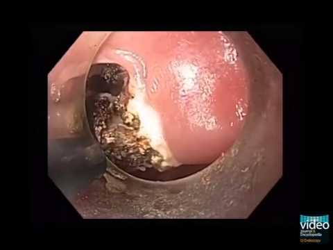 how to treat zenker's diverticulum