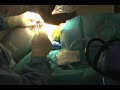 Opening Base Wedge Osteotomy for Hallux Valgus