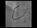 Normal Right Coronary Artery PA Cran Normal Right Coronary Artery PA Cran