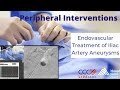 Endovascular Treatment of Iliac Artery Aneurysms - January 23, 2019
