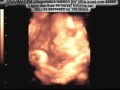GRAVIMAGEM 875 (ULTRA-SOM 3D 4D GRAVIDEZ COM 33 SEMANAS)
