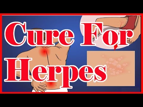 how to cure herpes