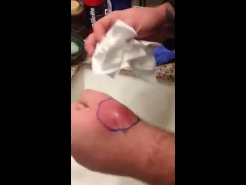 how to drain cellulitis