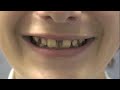 RPE Instruction – Smile Solutions Orthodontists