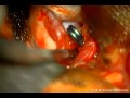 Cotton-Clipping Technique to Repair Intraoperative Aneurysm Neck Tear Video 3