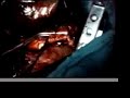 Clinical Case Aorta Substitution by Expandable Prosthesis