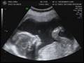 Sonogram of new baby