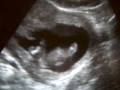 videos de Baby Girl Hughes 12/3/08 Sonogram #1