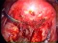severe-endometriosis-4-of-7.html