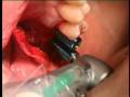 Live Dental Implant Surgery with a Sinus Lift And Bone Grafting