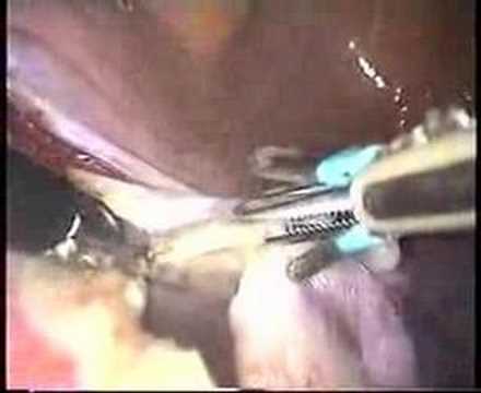 Total Abdominal Hysterectomy Procedure. Laparoscopic total