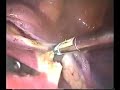 Laparoscopic total hysterectomy