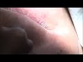CEREC Prep, Powder, and Picture