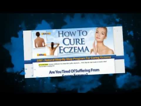 how to cure eczema on legs
