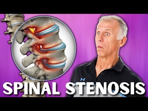 how to treat spinal stenosis