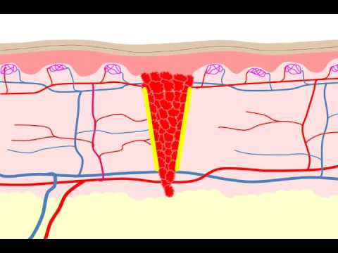 how to recover epidermis