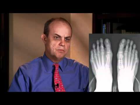 bunion