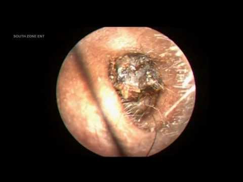 how to eliminate ear wax