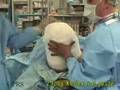 Bandaging a freshly above the knee amputated limb