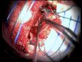 low-grade glioma right cingulate gyrus.mpg