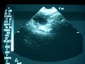 www.proceptin.com Here is a live shot of a video shot while doing an ultrasound of a women who is trying to get pregnant. Dr. Steven Brody is a fertility expert and the creator of www.Proceptin.com which enhances healthy sperm counts in men. For more questions about male and female fertility conact Dr. Brody at blueshine@cox.net or go to his website at www.proceptin.com for information on male fertility