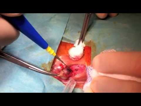 how to drain hemorrhoids