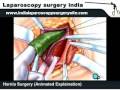 Laparoscopic Robotic assisted resection of duodenal and small bowel diverticula in India