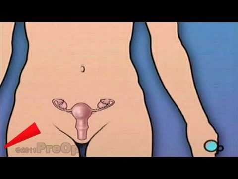 ovaries - http://on.fb.me/PreOp_com - NEW facebook page - it's cool! Patient Education Company Your doctor has recommended that you have a hysterectomy with the remova...