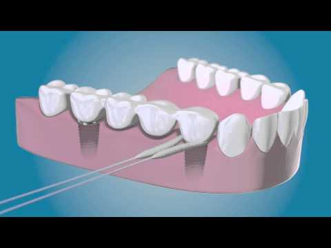 SINUSITIS MAXILAR DE CAUSA ODONTÓGENA