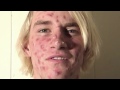 ZIT FACE GUY - ACNE EXPLOSION!!!!!