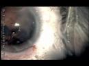 During this routine phaco, J-Cannula Became Loose and Ejected into the eye at a very high pressure. This happened as the nurse, which is one of my best nurses, did not tighten the J-cannula to the syringe. This resulted in PC tear, retinal/chorioidal trauma with vitreous hge. This was managed by immediately injecting Vitrax into the vitreous cavity, 2 vials were needed. Anterior vitrectomy was done and the IOL AR40e was implanted into the sulcus with rhexis capture, where you push the optic behind the CCC. First PO day vision was 20/40. On the last visit, UCVA was 20/25+1, not bad. I did 2 retina lasers around the area where the cannula hit the retina. Thank God, this nice patient is doing fine.