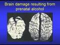 Fetal Alcohol Syndrome & Fetal Alcohol Effects Video Part 1