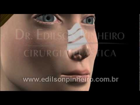 brazil plastic surgery - Before and After in 3D of Nose Surgery - Rhinoplasty - Brazilian Plastic Surgery.