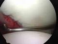 Arthroscopy: Recurrent Shoulder Dislocator by Ford Qureshi
