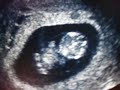 november 8, 2007 was the first time we saw our baby. we heard, and saw it's heart beating.  and it looked like it was waving at us with its little arm buds.
