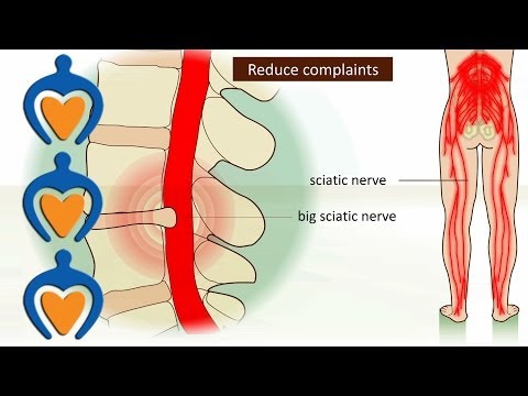 how to relieve sciatic nerve pain fast