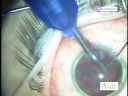 Michael Orr, MD Cataract Surgery