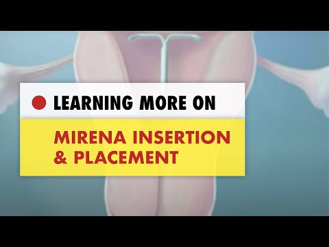 how to fit iud